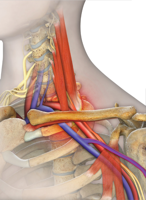 Thoracic outlet syndrome