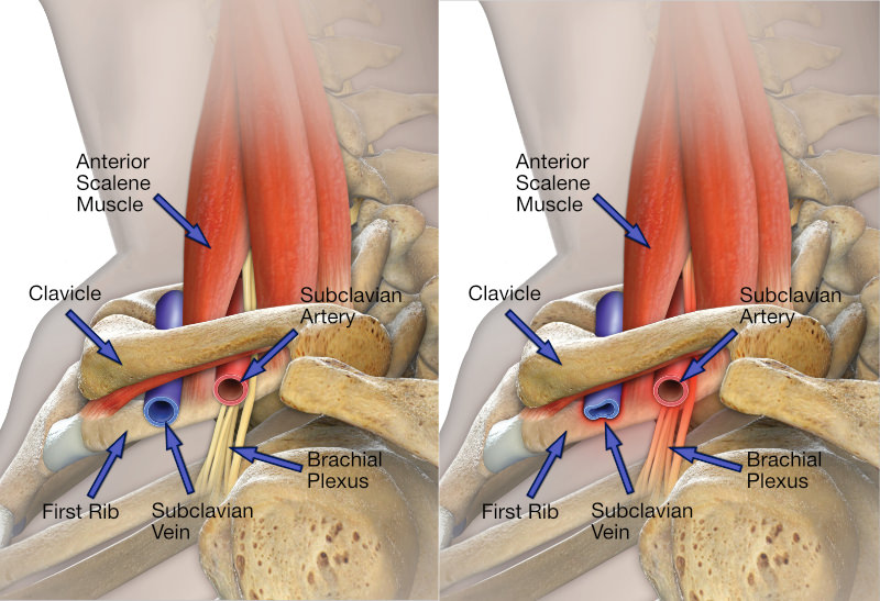 On the left, normal anatomy. On the right, the abnormal thoracic outlet compresses the vein, artery, and nerves.